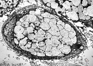 F, 75y. | skin metastasis of mucinous adenocarcinoma F, 75y. | skin metastasis of mucinous adenocarcinoma